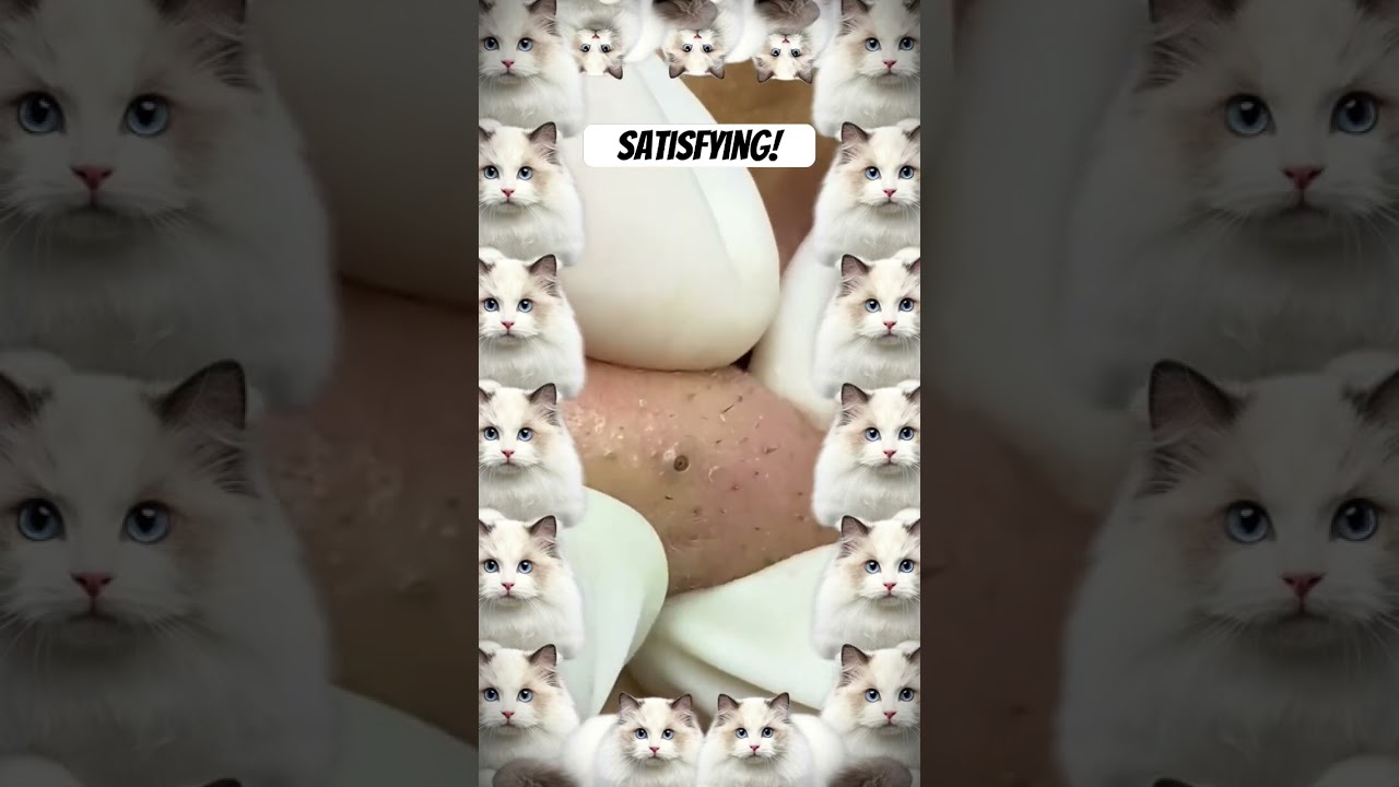 Wow! #pimple #pimples #pimplepopping #shortsfeed #shortvideo #shorts #short #youtubeshorts #youtube
