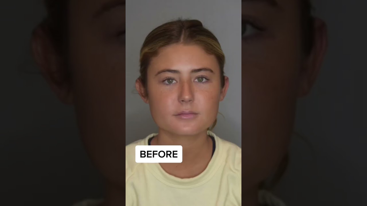 Buccal Fat Removal BEFORE & AFTER #plasticsurgery #beforeandafter #contour #snatched