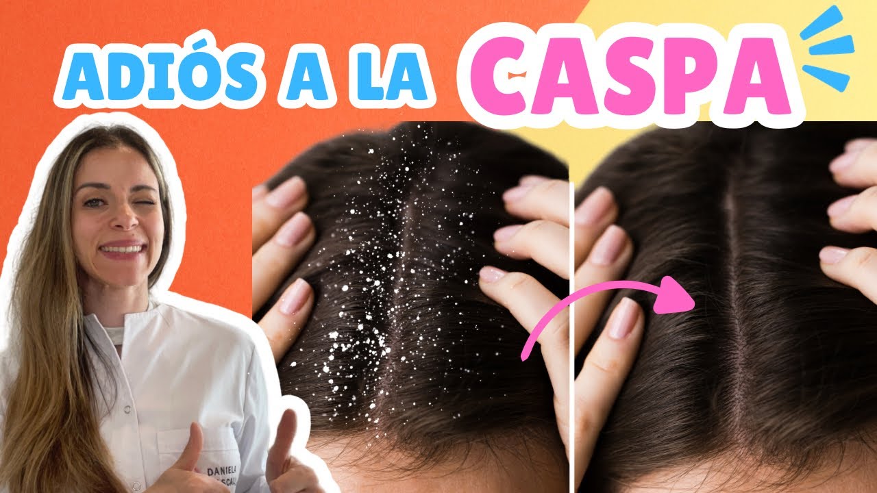 LA SOLUCIÓN PARA LA CASPA | HACÉ ESTO SI TENÉS CASPA