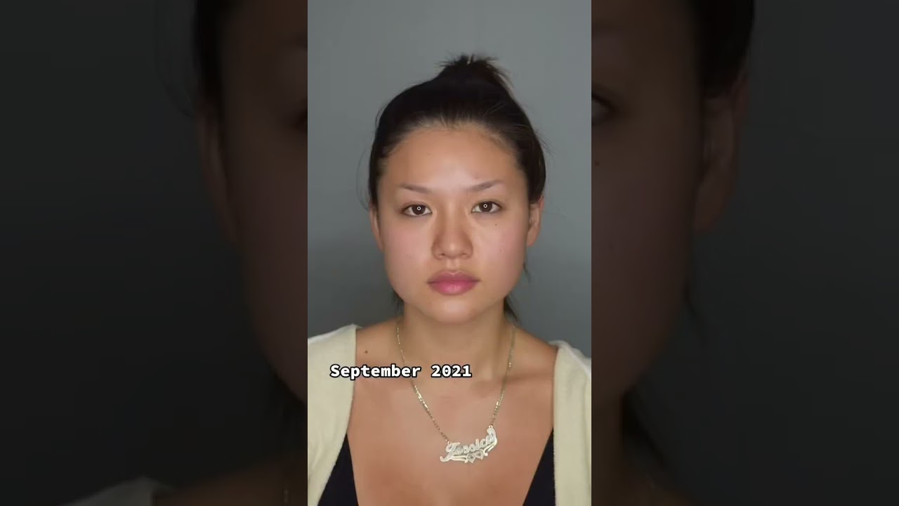 Buccal Fat Removal BEFORE & AFTER #beforeandafter #plasticsurgery #glowup #buccalfatremoval