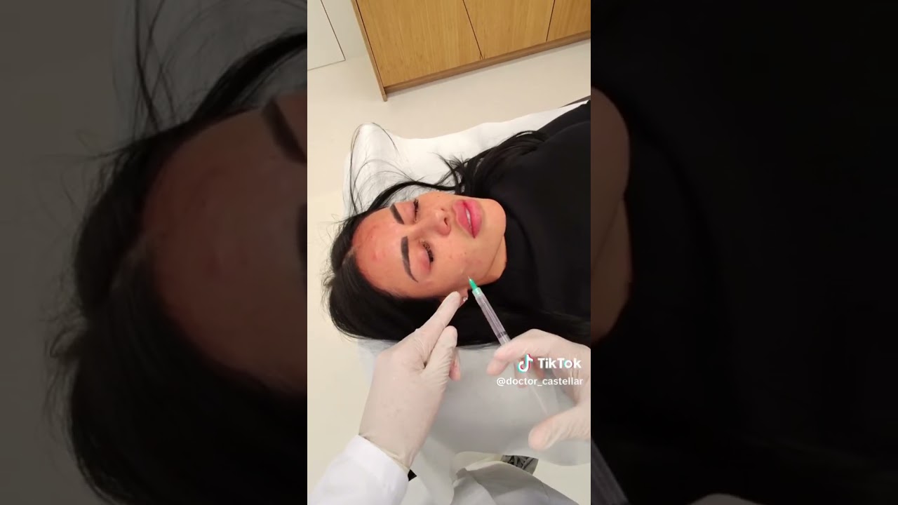 CANELA SKIN FACIAL PROCEDURE 💉 @doctorcastellar2252