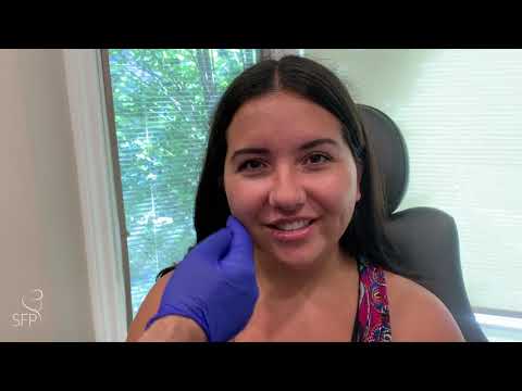 Buccal Fat Removal Surgery | 3 Weeks Before & After Results | by Dr. Philip Solomon